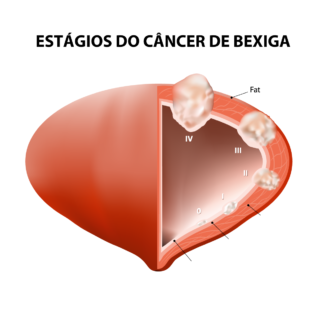 cancer-bexiga-uroclinica