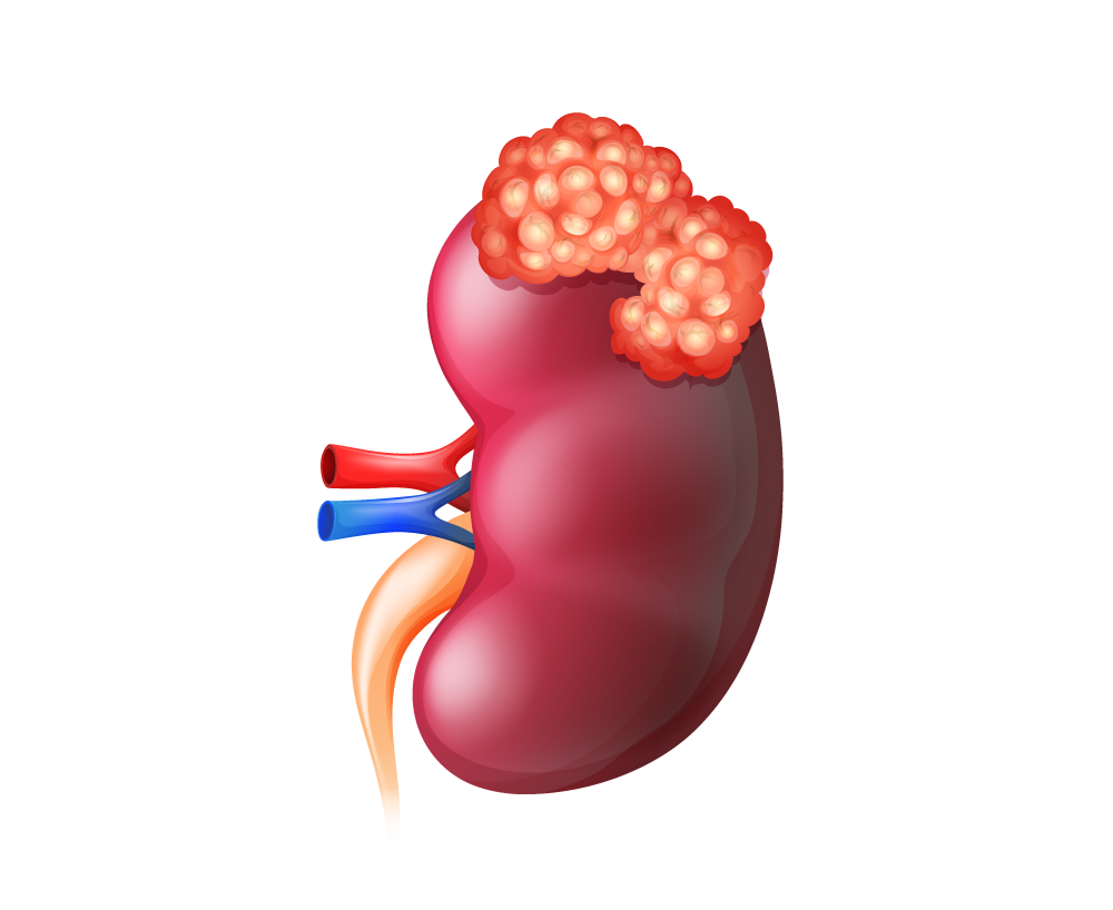 Câncer de rim – Uroclinica