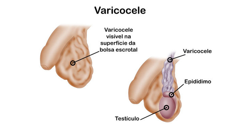 uroclinica-clinica-urologia-joinville-varicocele-02