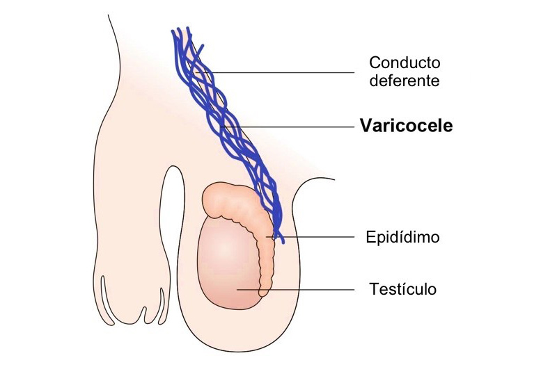 uroclinica-clinica-urologia-joinville-varicocele-03